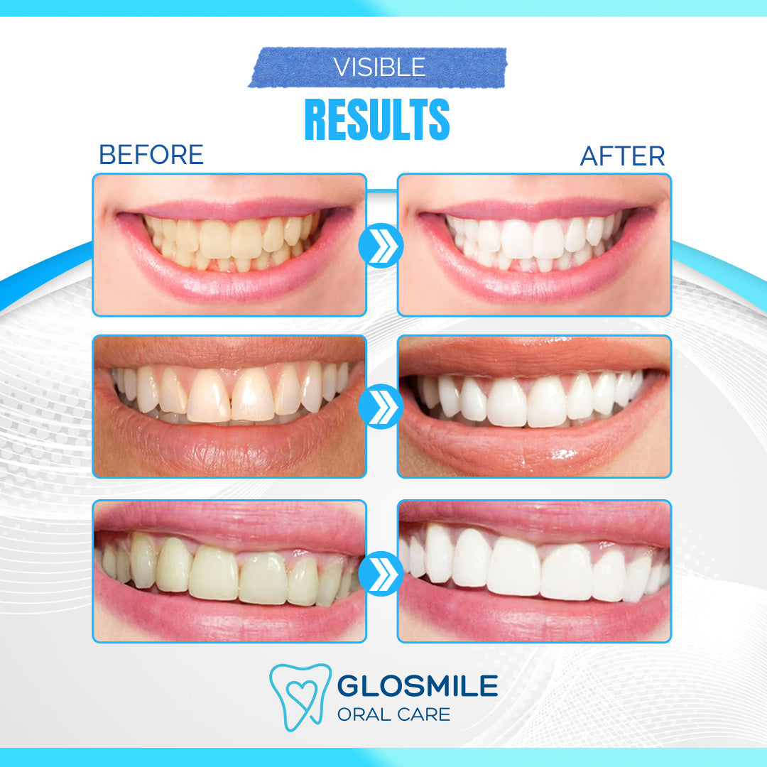 GloSmile Home-Use Teeth Whitening Kit with Led Light