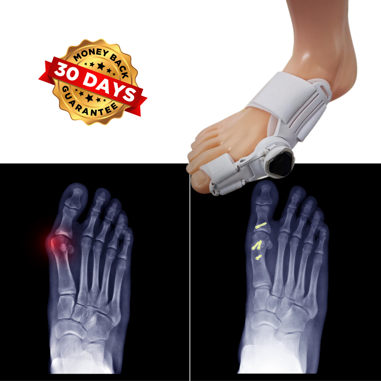 ToeAlign™ Mechanical Bunion Corrector Brace