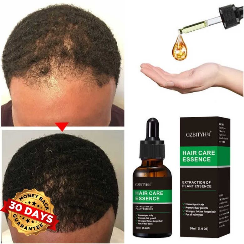 Hair Growth Oil - Fill In Bald Spots Naturally in 10 Days!